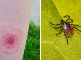 “Puntura di zecca: cosa devi sapere” Indicazioni utilissime per gli escursionisti del Laceno